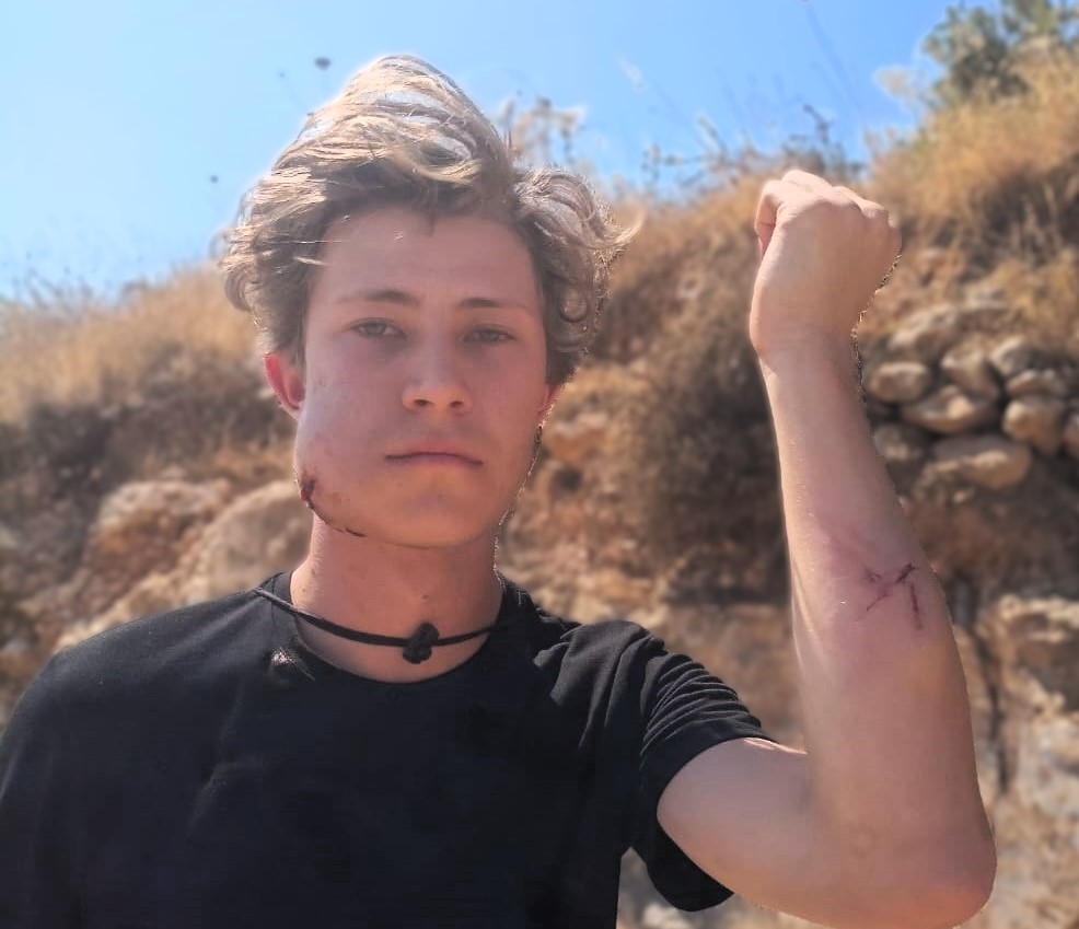 المتضامن الأجنبي الذي تعرض للاعتداء من قبل المستعمرين